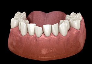 Picture of crowded teeth